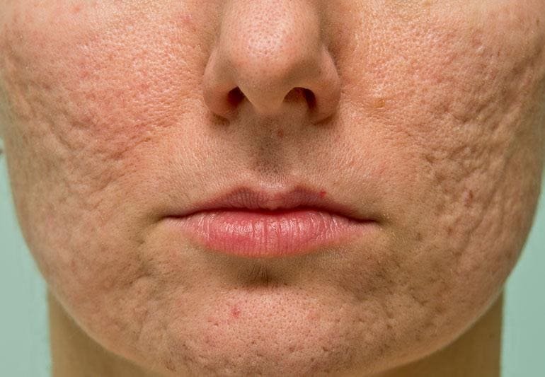 Acne Scar