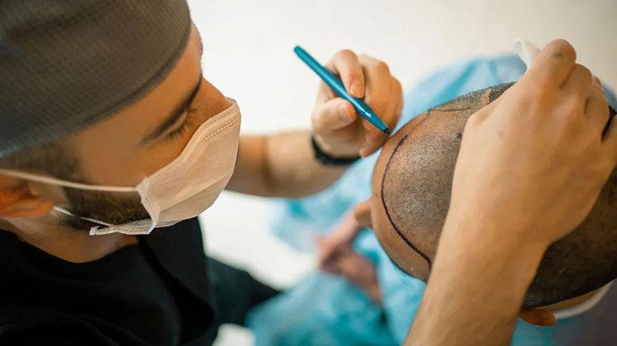 Hair Transplantation