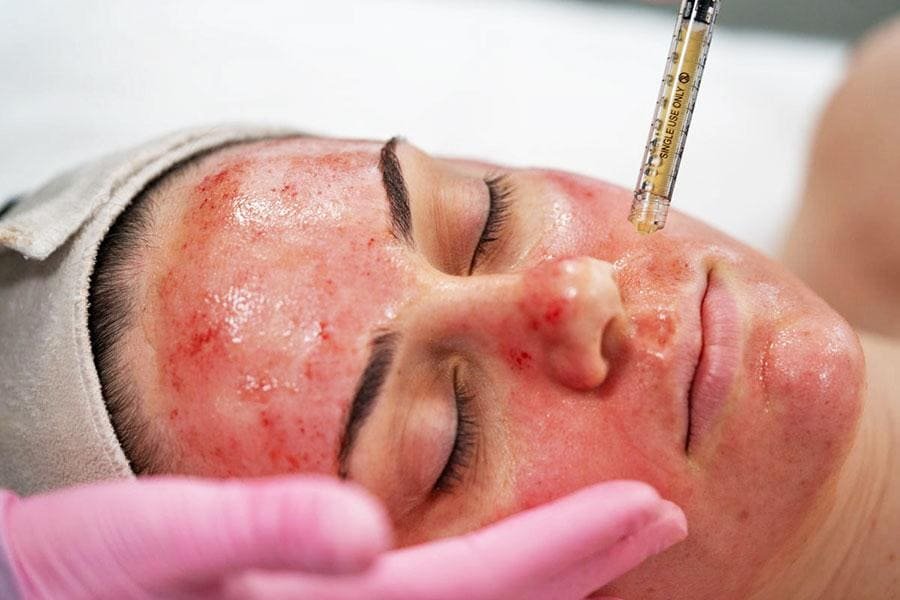 Vampire Facial / Face PRP