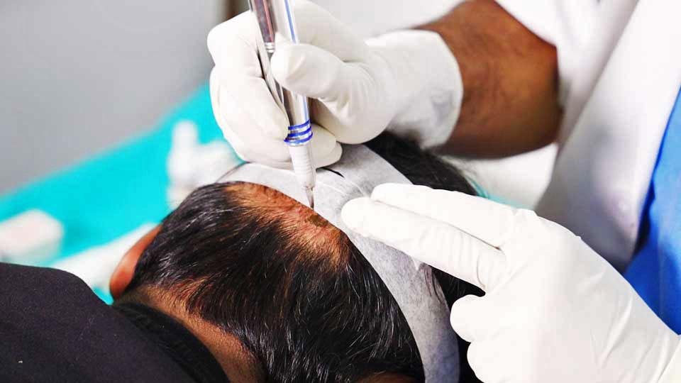 SMP (Scalp Micro Pigmentation)