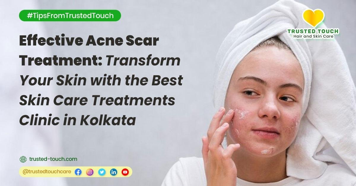 Effective Acne Scar Treatment: Transform Your Skin with the Best Skin Care Treatments Clinic in Kolkata