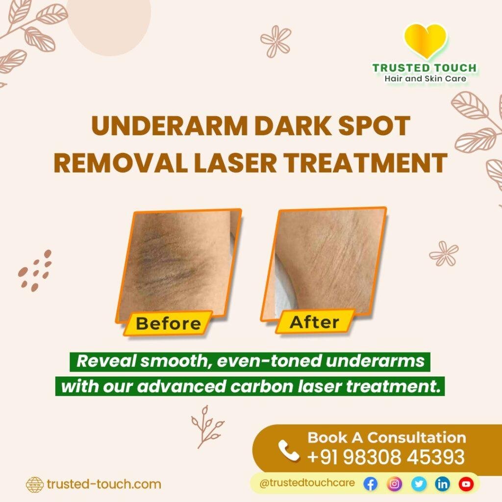 Underarm Dark Spot Removal Treatment