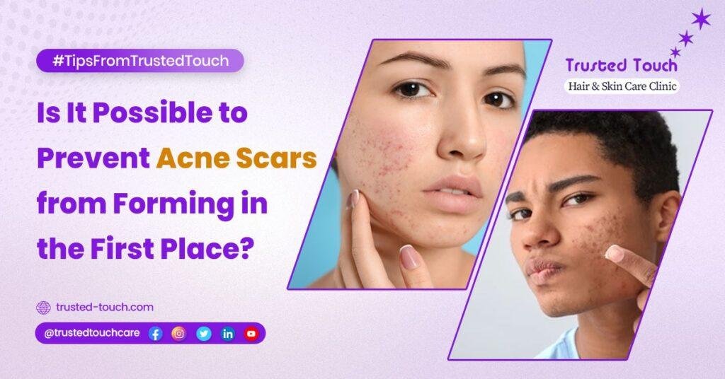 Is It Possible to Prevent Acne Scars from Forming in the First Place?<