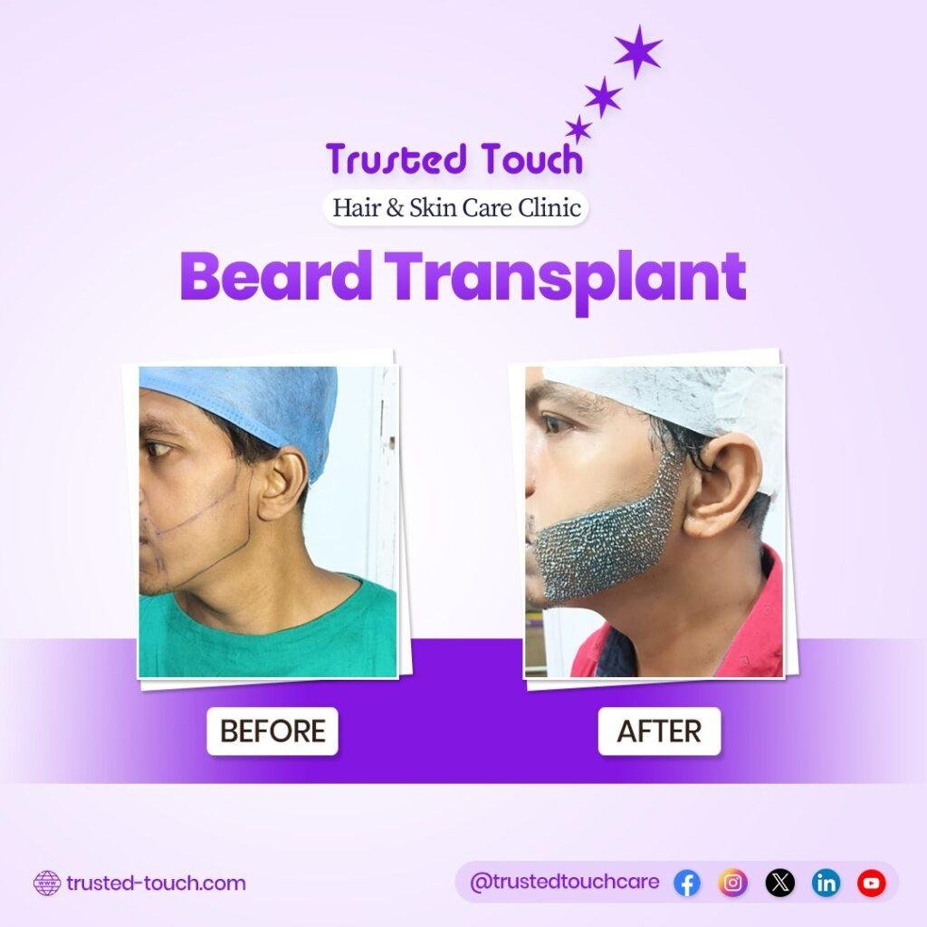 Beard Transplant