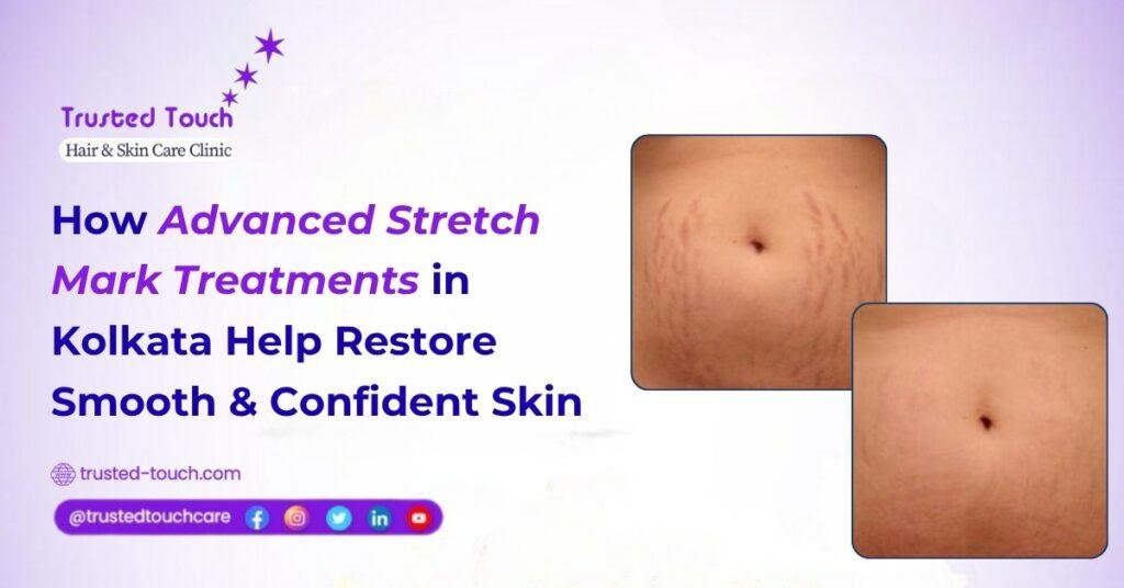 How Advanced Stretch Mark Treatments in Kolkata Help Restore Smooth & Confident Skin