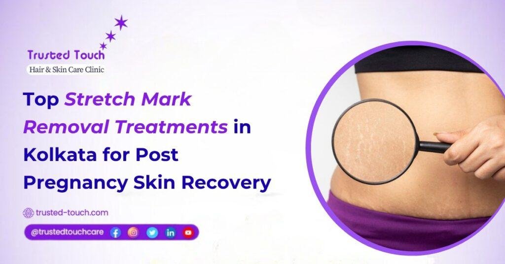 Top Stretch Mark Removal Treatments in Kolkata for Post Pregnancy Skin Recovery
